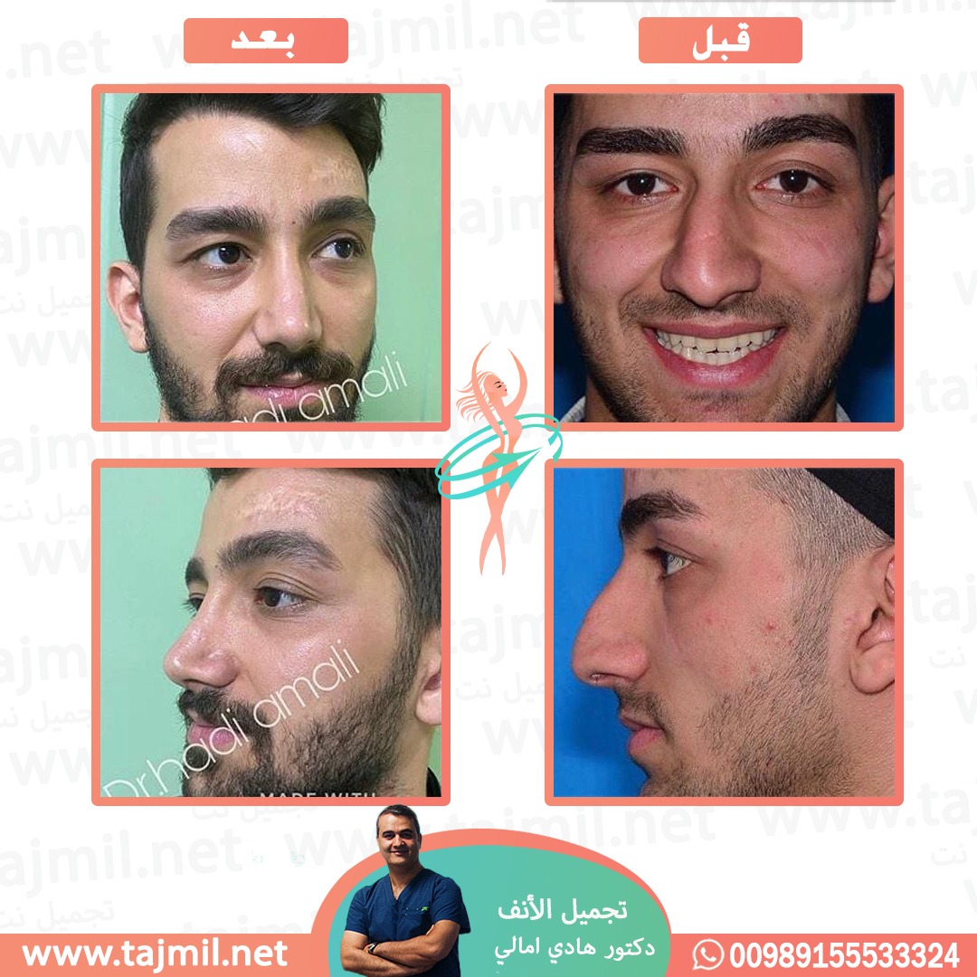  - دکتور هادي امالي عملية تجميل الأنف في ايران مع تجميل نت