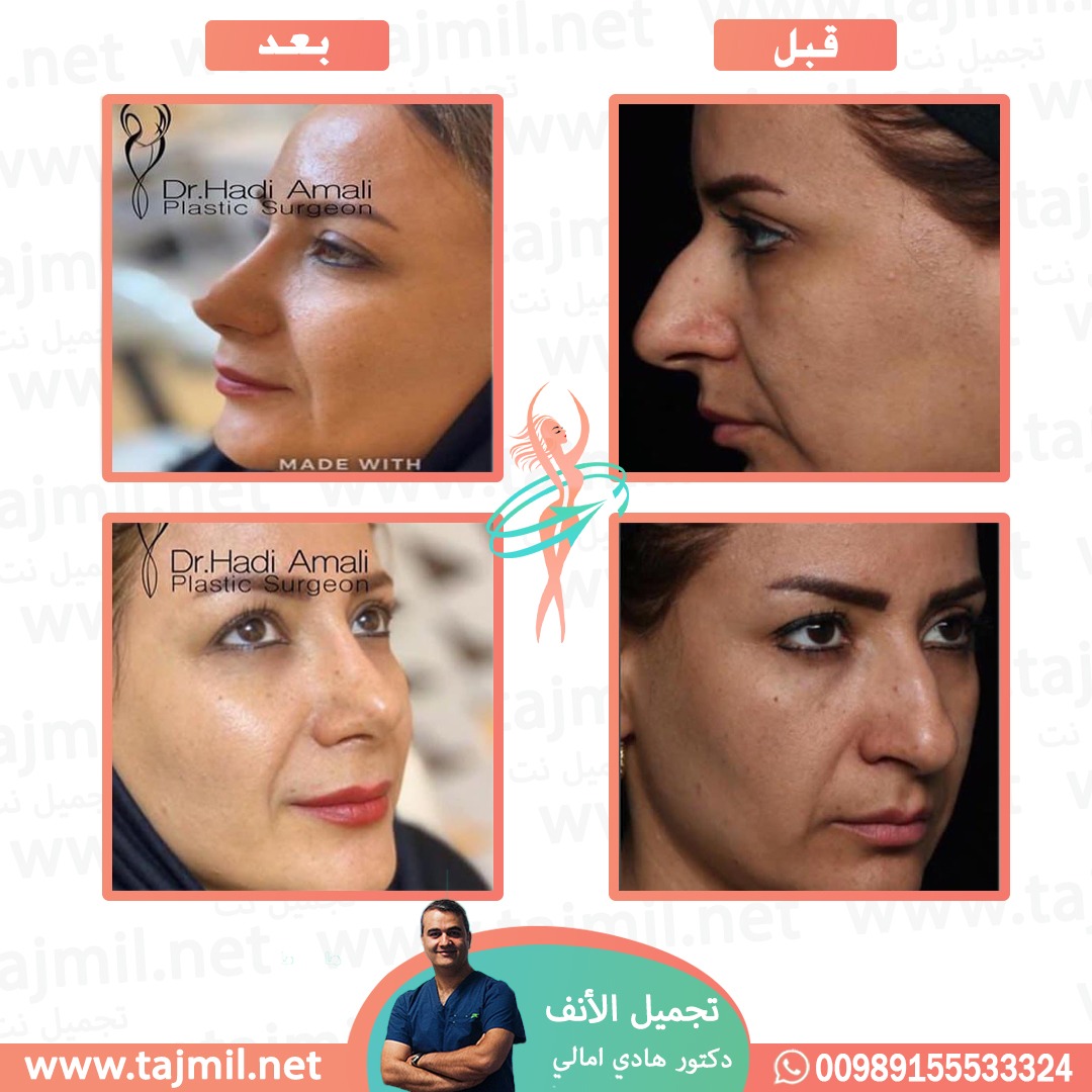  - دکتور هادي امالي عملية تجميل الأنف في ايران مع تجميل نت