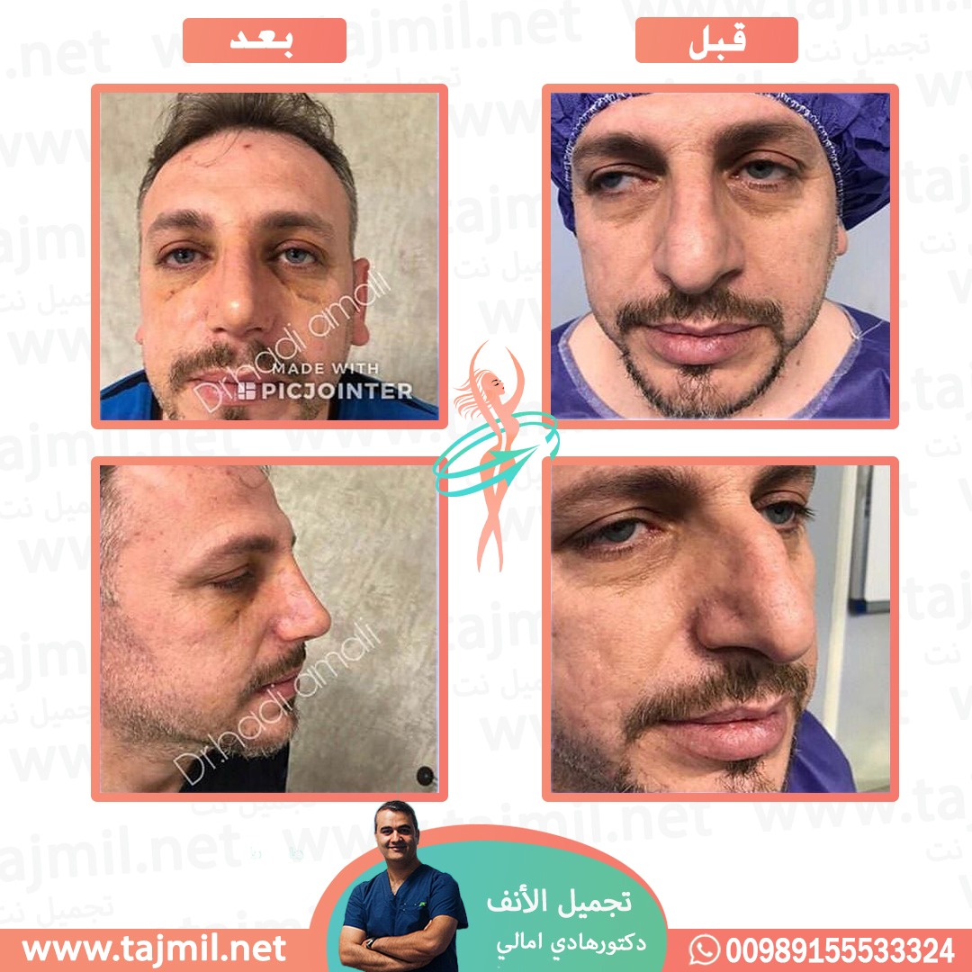  - دکتور هادي امالي عملية تجميل الأنف في ايران مع تجميل نت