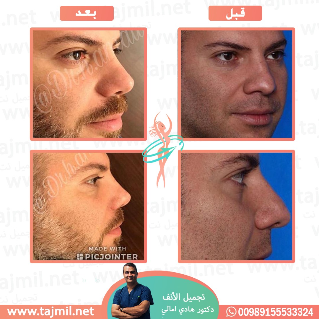  - دکتور هادي امالي عملية تجميل الأنف في ايران مع تجميل نت