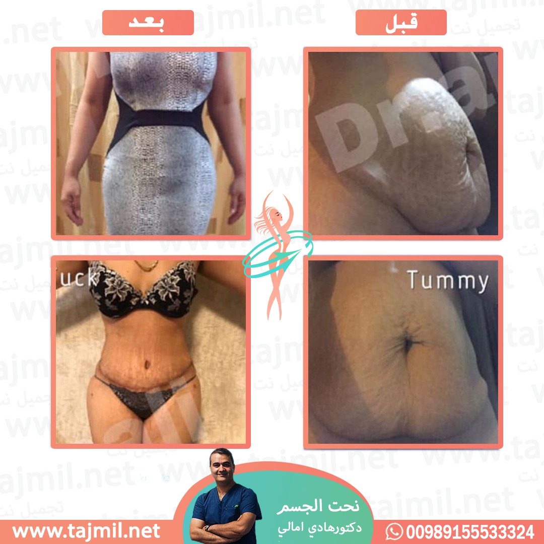  - دکتور هادي امالي عملية نحت الجسم في ايران مع تجميل نت