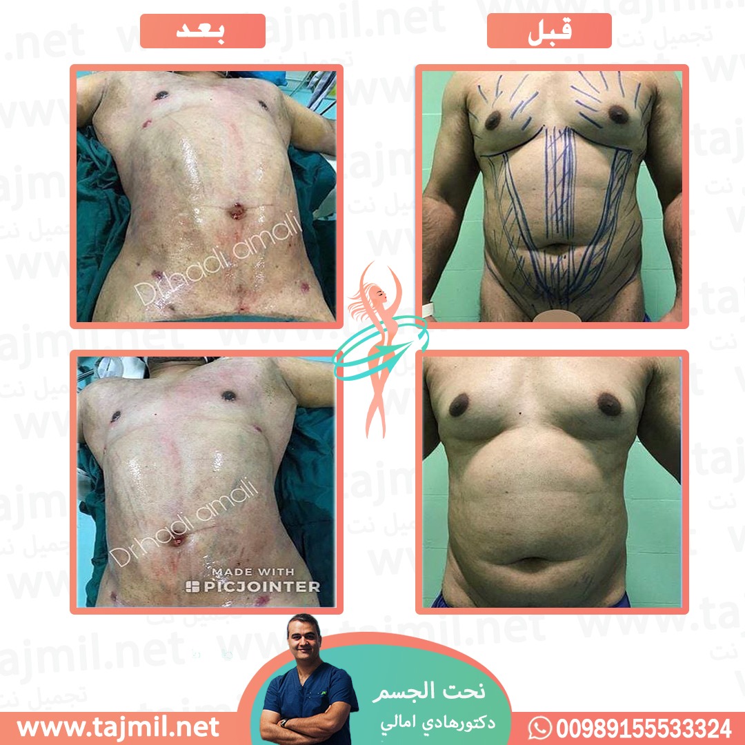  - دکتور هادي امالي عملية نحت الجسم في ايران مع تجميل نت