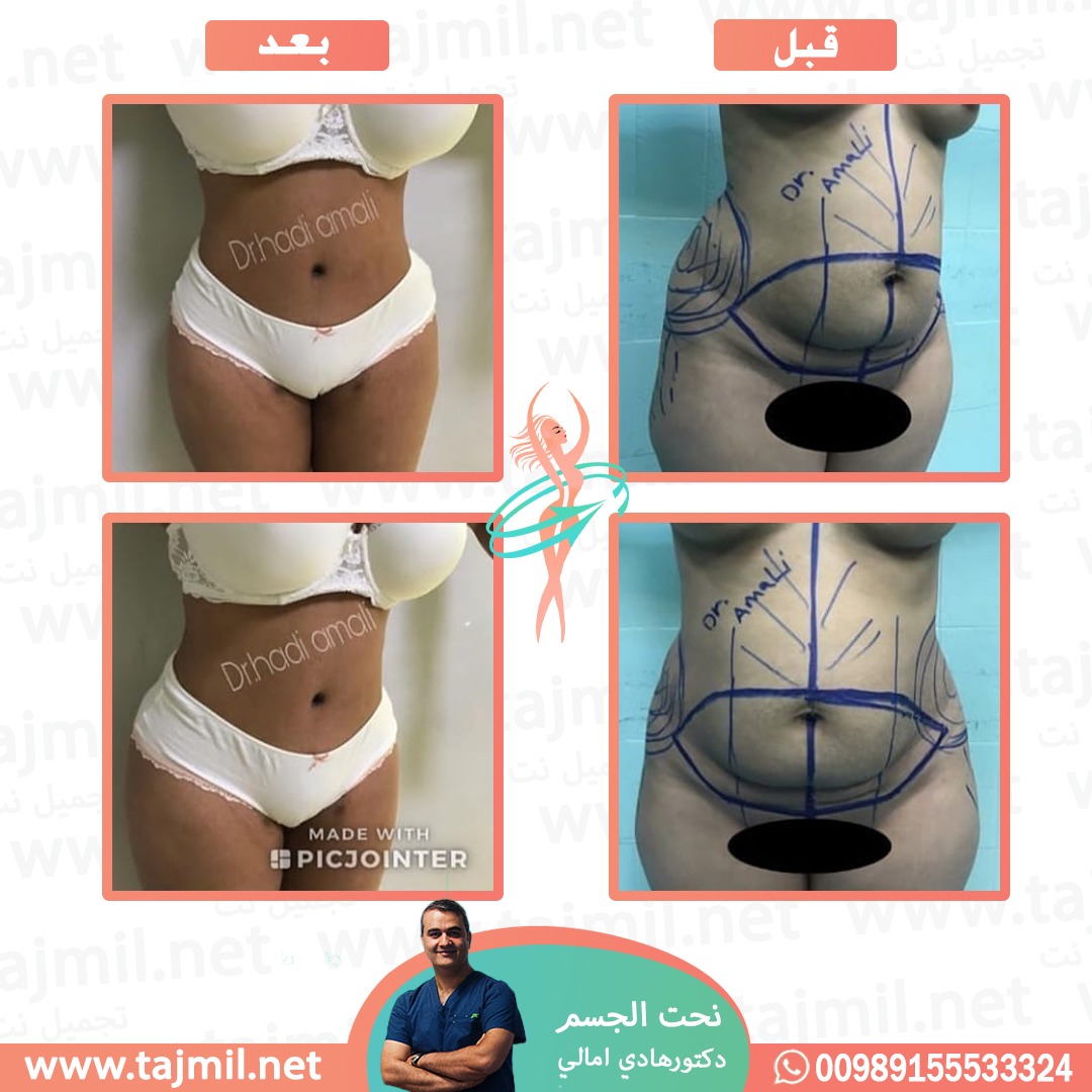  - دکتور هادي امالي عملية نحت الجسم في ايران مع تجميل نت