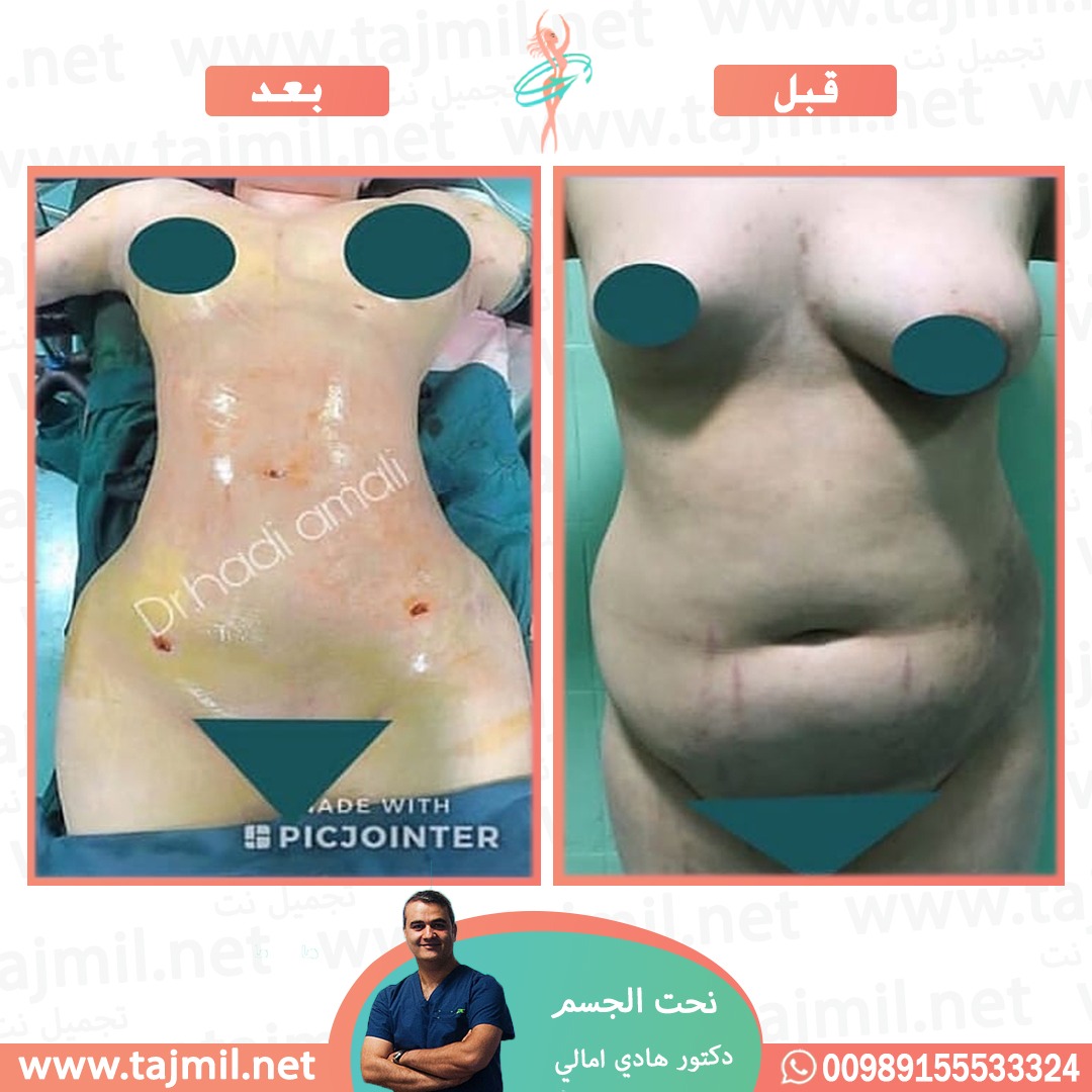  - دکتور هادي امالي عملية نحت الجسم في ايران مع تجميل نت