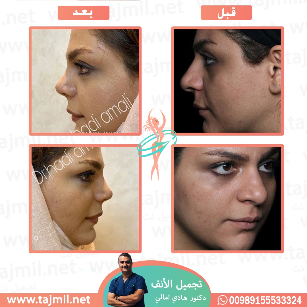  - دکتور هادي امالي عملية تجميل الأنف في ايران مع تجميل نت