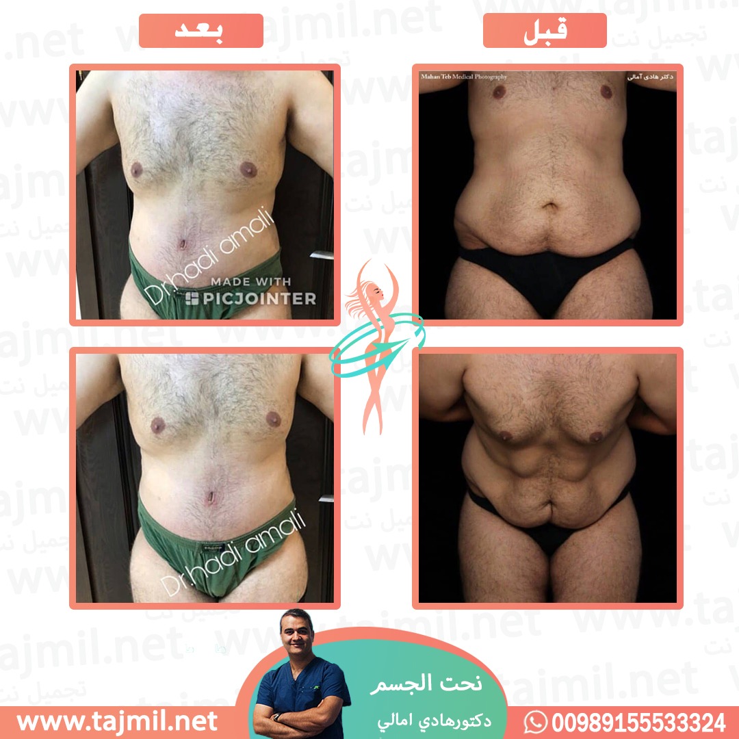  - دکتور هادي امالي عملية نحت الجسم في ايران مع تجميل نت