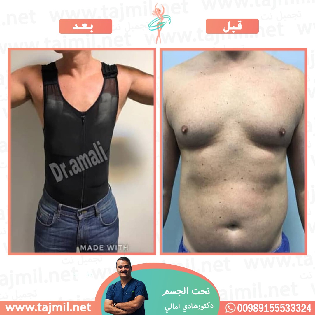  - دکتور هادي امالي عملية نحت الجسم في ايران مع تجميل نت