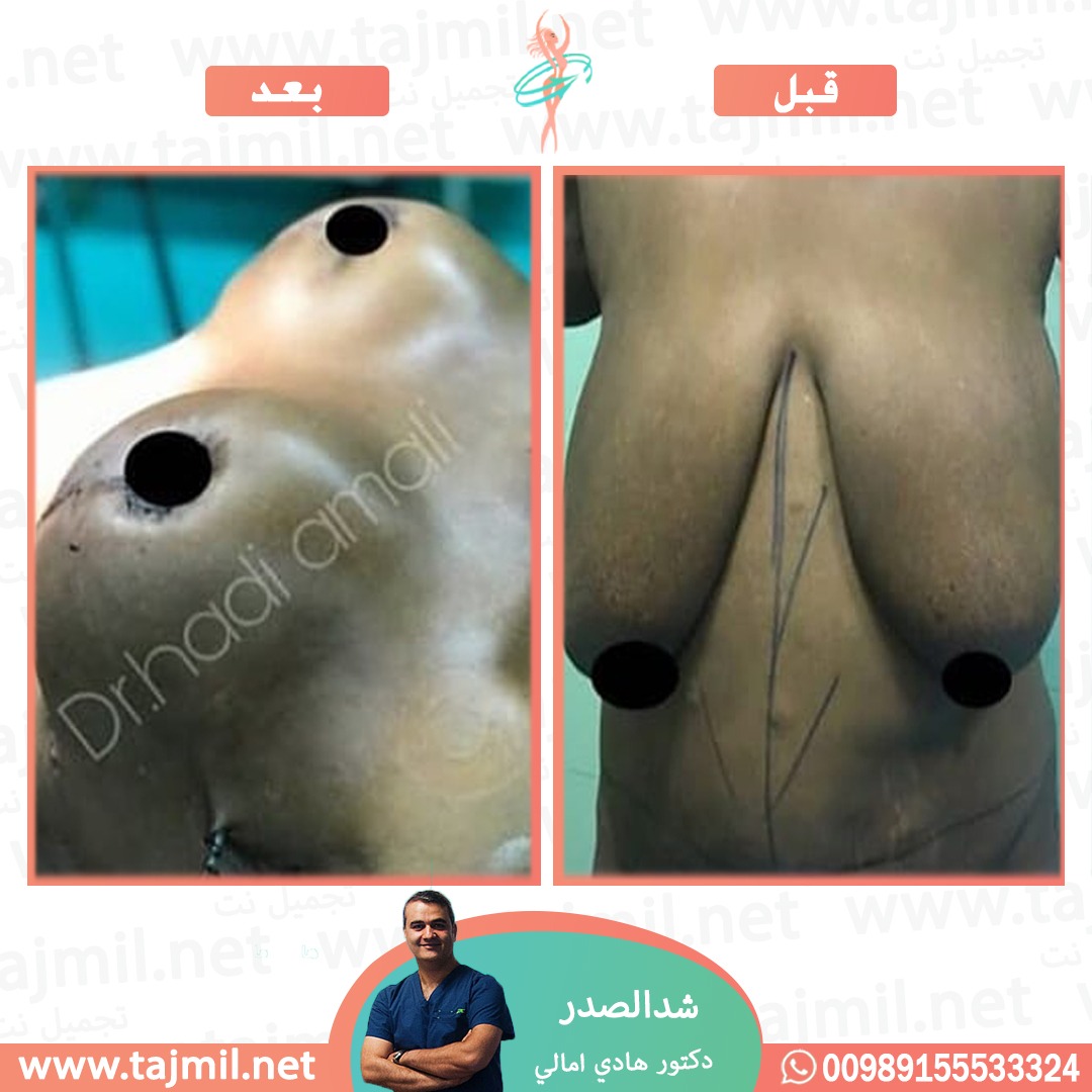  - دکتور هادي امالي عملية شد الصدر في ايران مع تجميل نت