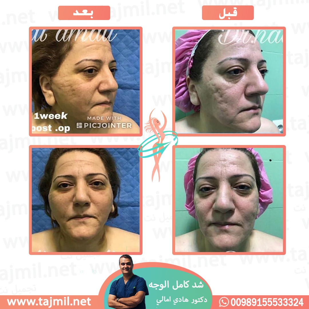  - دکتور هادي امالي عملية شد کامل الوجه  في ايران مع تجميل نت