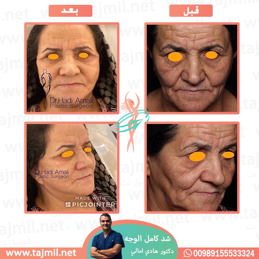  - دکتور هادي امالي عملية شد کامل الوجه  في ايران مع تجميل نت