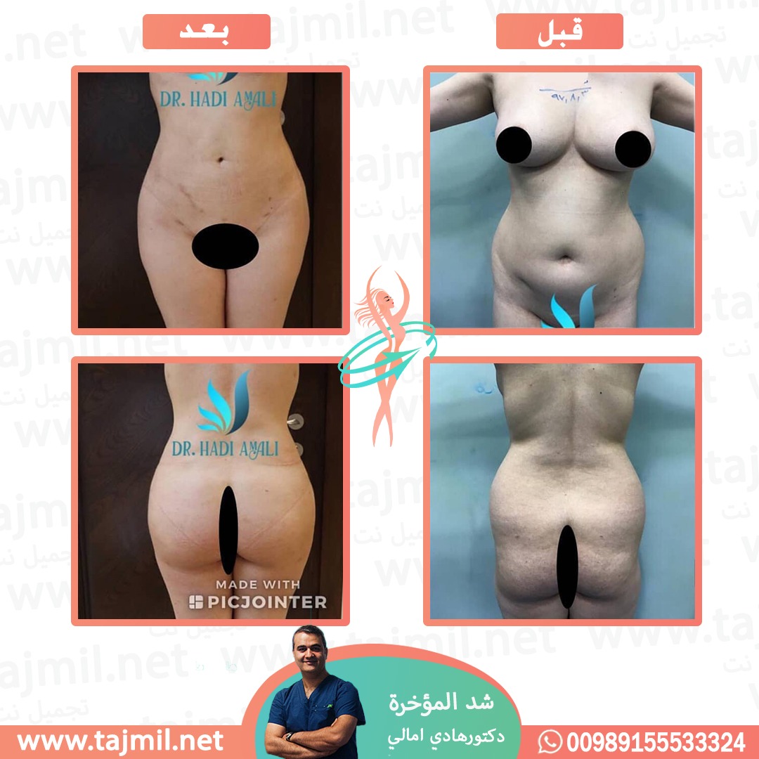  - دکتور هادي امالي عملية شد المؤخره  في ايران مع تجميل نت