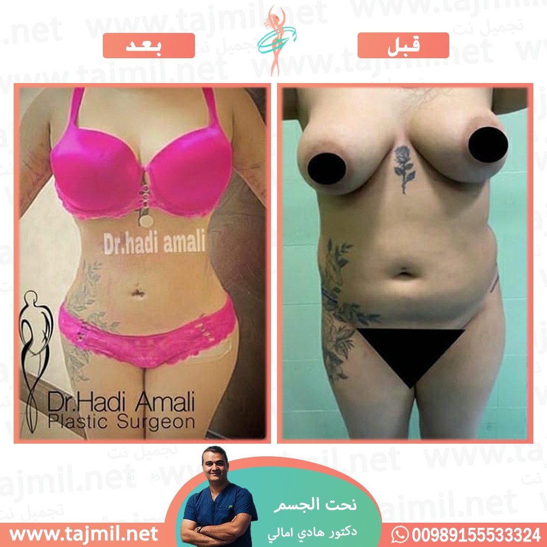  - دکتور هادي امالي عملية نحت الجسم في ايران مع تجميل نت