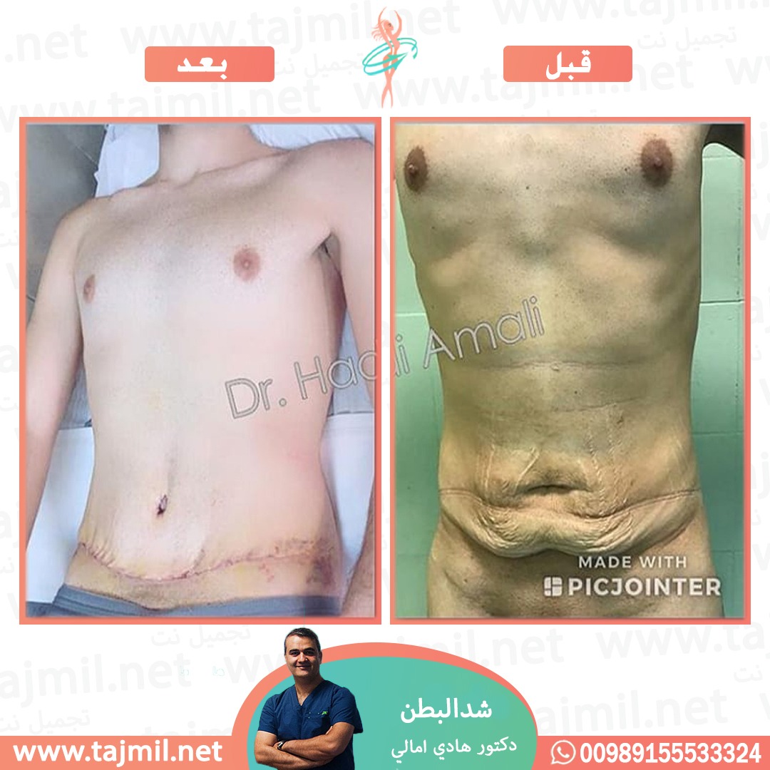  - دکتور هادي امالي عملية شد البطن  في ايران مع تجميل نت