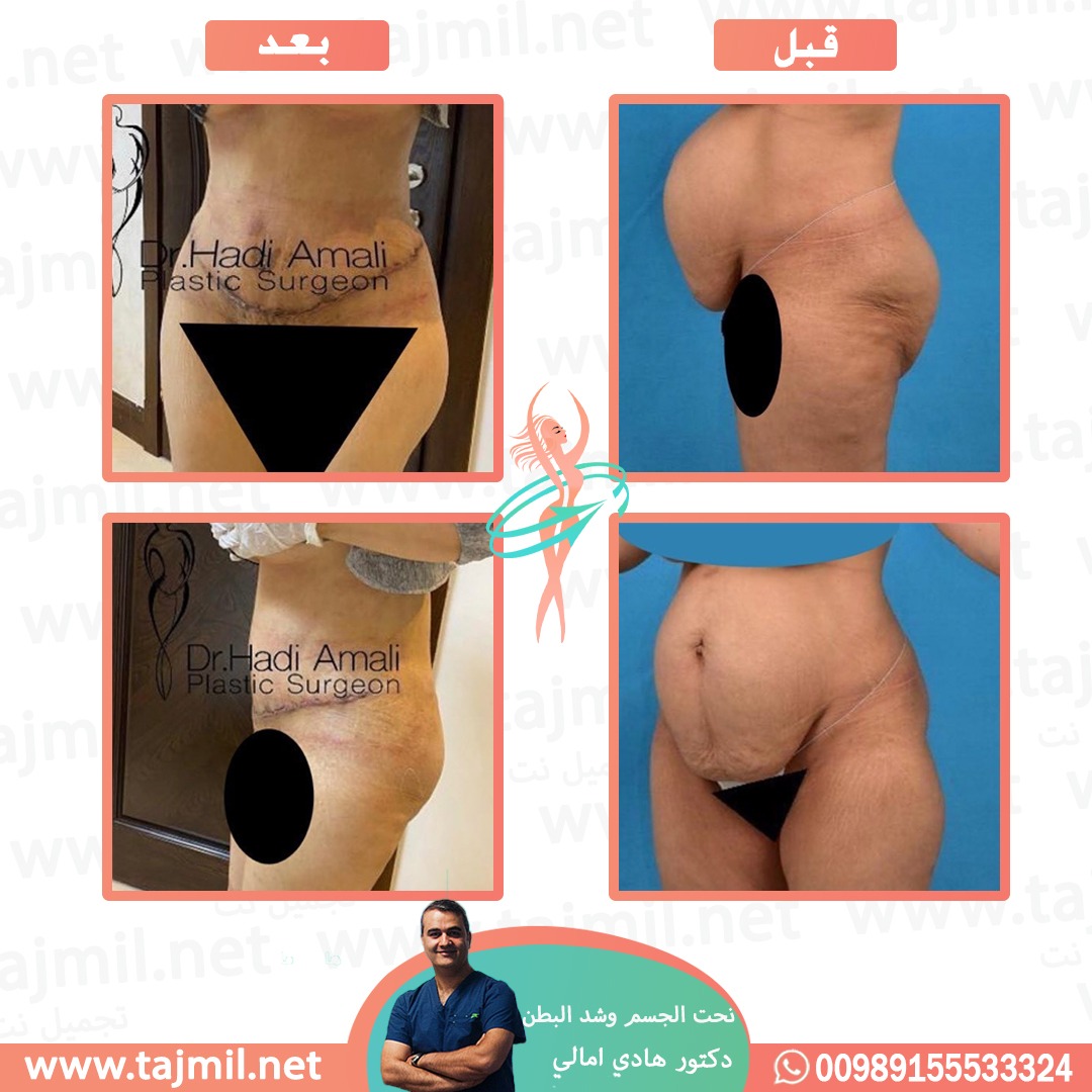  - دکتور هادي امالي عملية نحت الجسم  و شد البطن في ايران مع تجميل نت