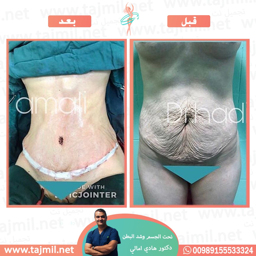  - دکتور هادي امالي عملية نحت الجسم  و شد البطن في ايران مع تجميل نت