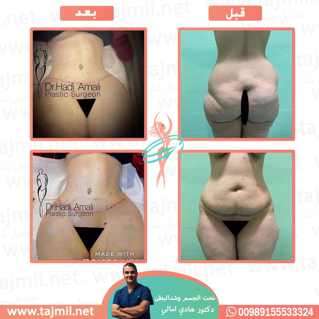  - دکتور هادي امالي عملية نحت الجسم  و شد البطن في ايران مع تجميل نت