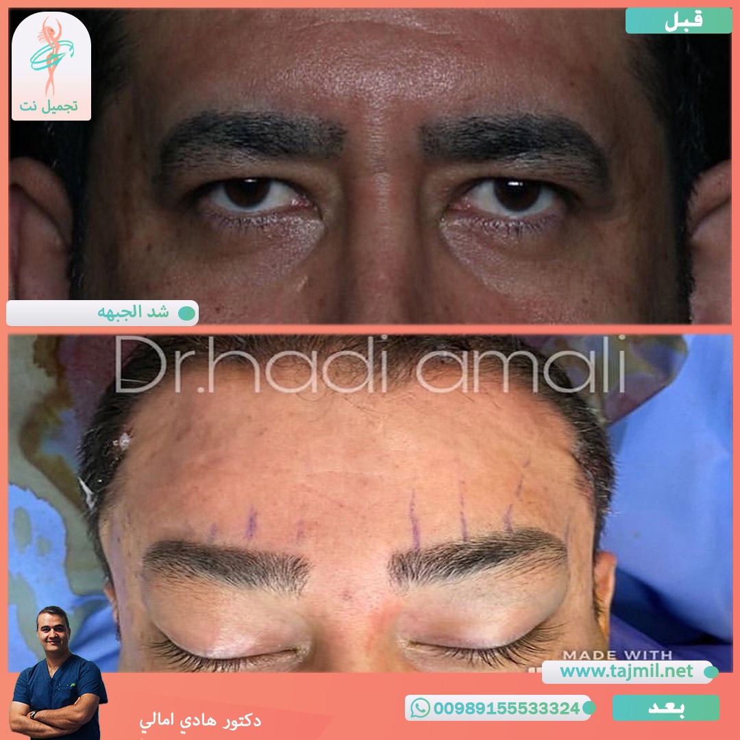  - دکتور هادي امالي عملية شد الجبهه في ايران مع تجميل نت