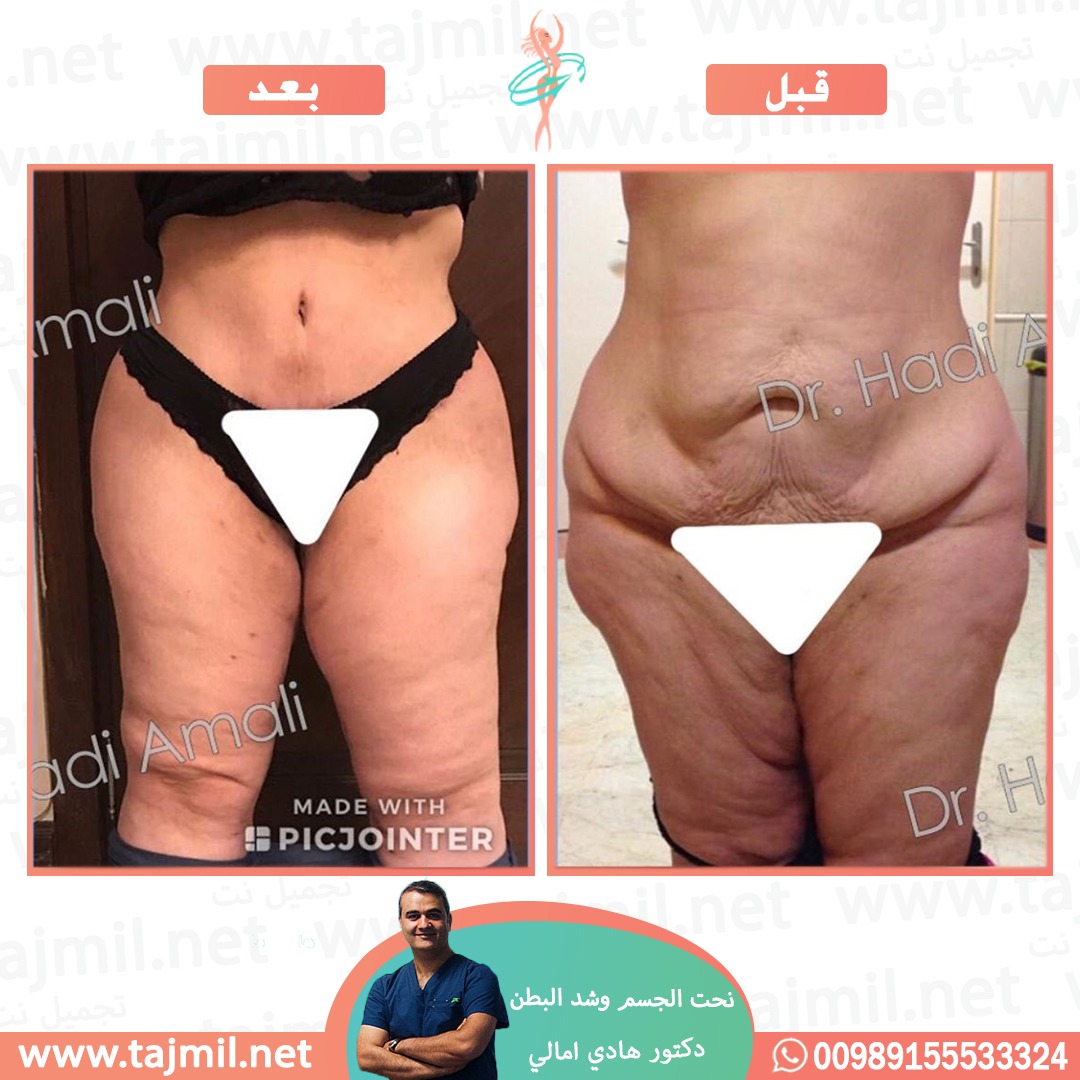  - دکتور هادي امالي عملية نحت الجسم  و شد البطن في ايران مع تجميل نت