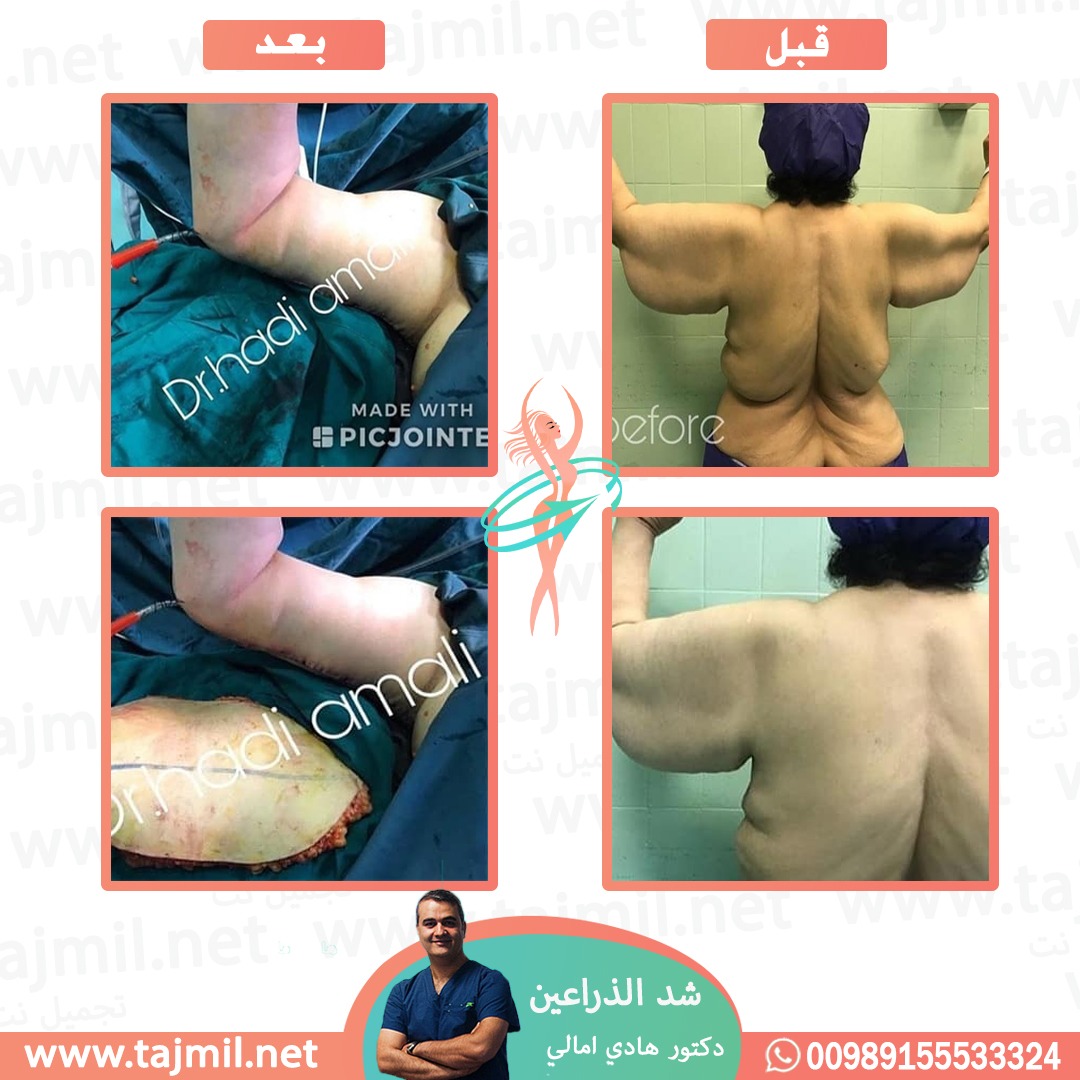  - دکتور هادي امالي عملية شد الذراعین  في ايران مع تجميل نت