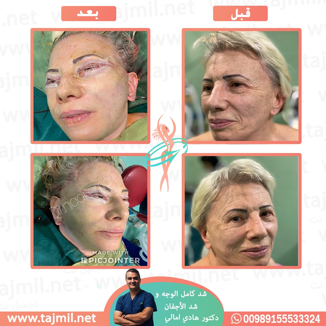  - دکتور هادي امالي عملية شد کامل الوجه شد الأجفان في ايران مع تجميل نت