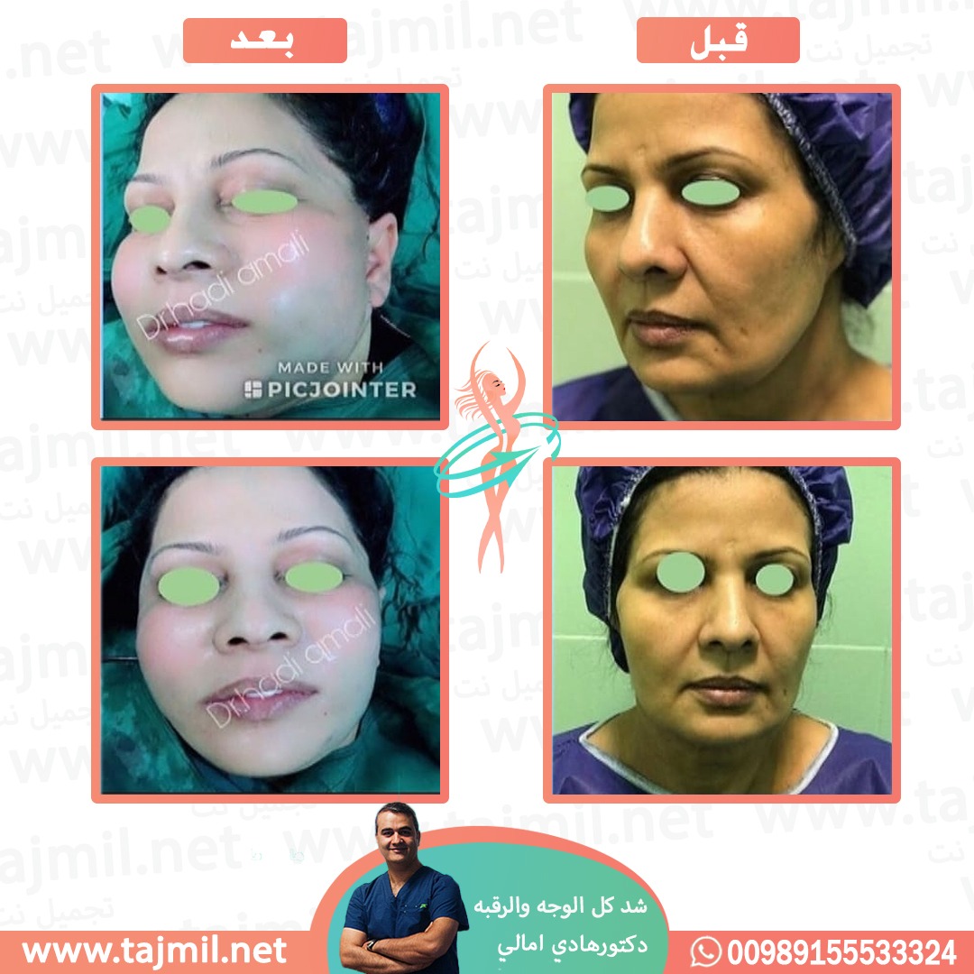  - دکتور هادي امالي عملية شد کامل الوجه و الرقبه في ايران مع تجميل نت