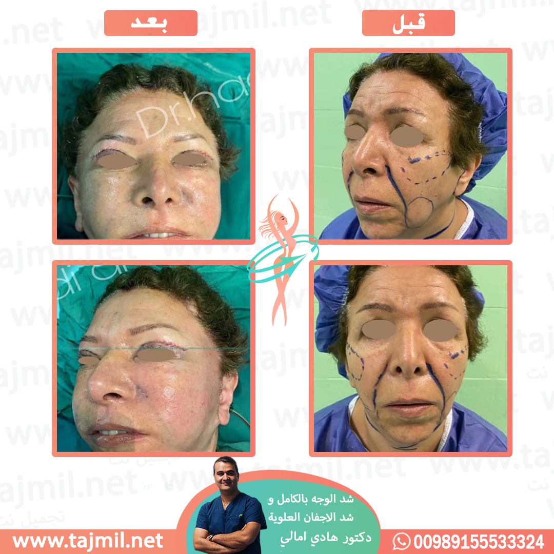  - دکتور هادي امالي عملية شد الوجه بالکامل و شد الأجفان العلویة في ايران مع تجميل نت