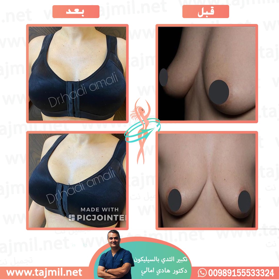  - دکتور هادي امالي عملية تکبیر الثدي بالسیلیکون في ايران مع تجميل نت