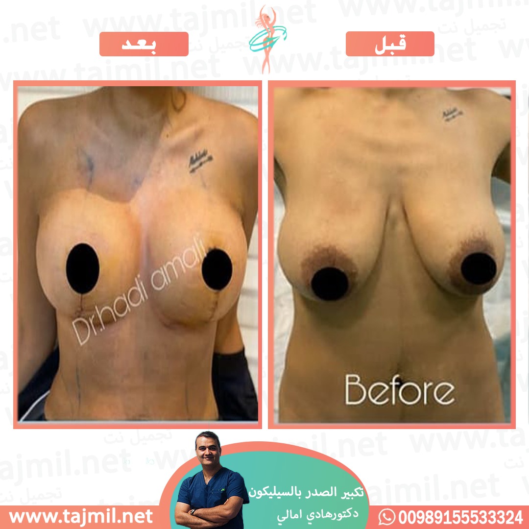  - دکتور هادي امالي عملية تکبیر الصدر بالسیلیکون في ايران مع تجميل نت