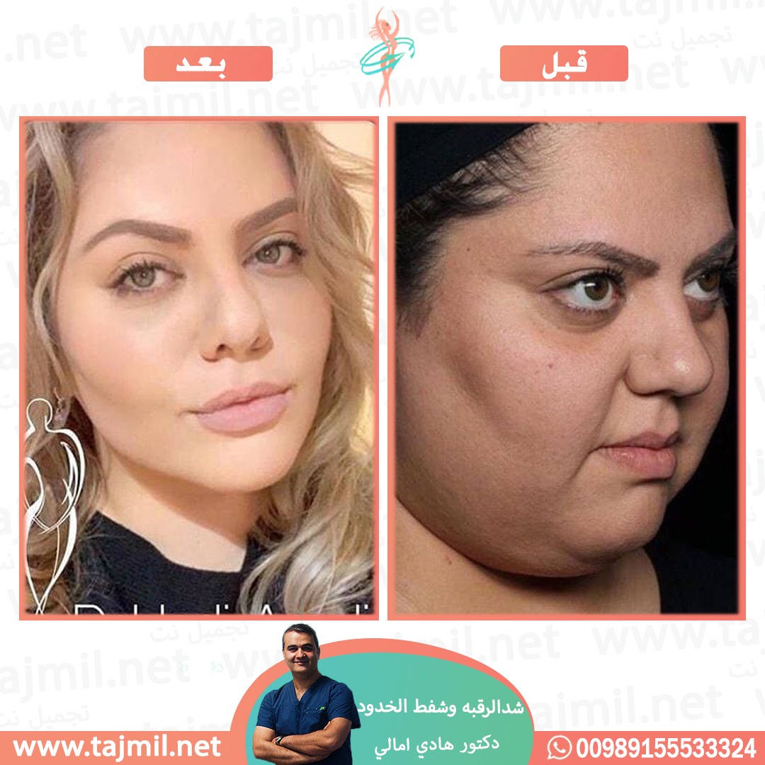  - دکتور هادي امالي عملية شد الرقبه و شفط الخدود في ايران مع تجميل نت