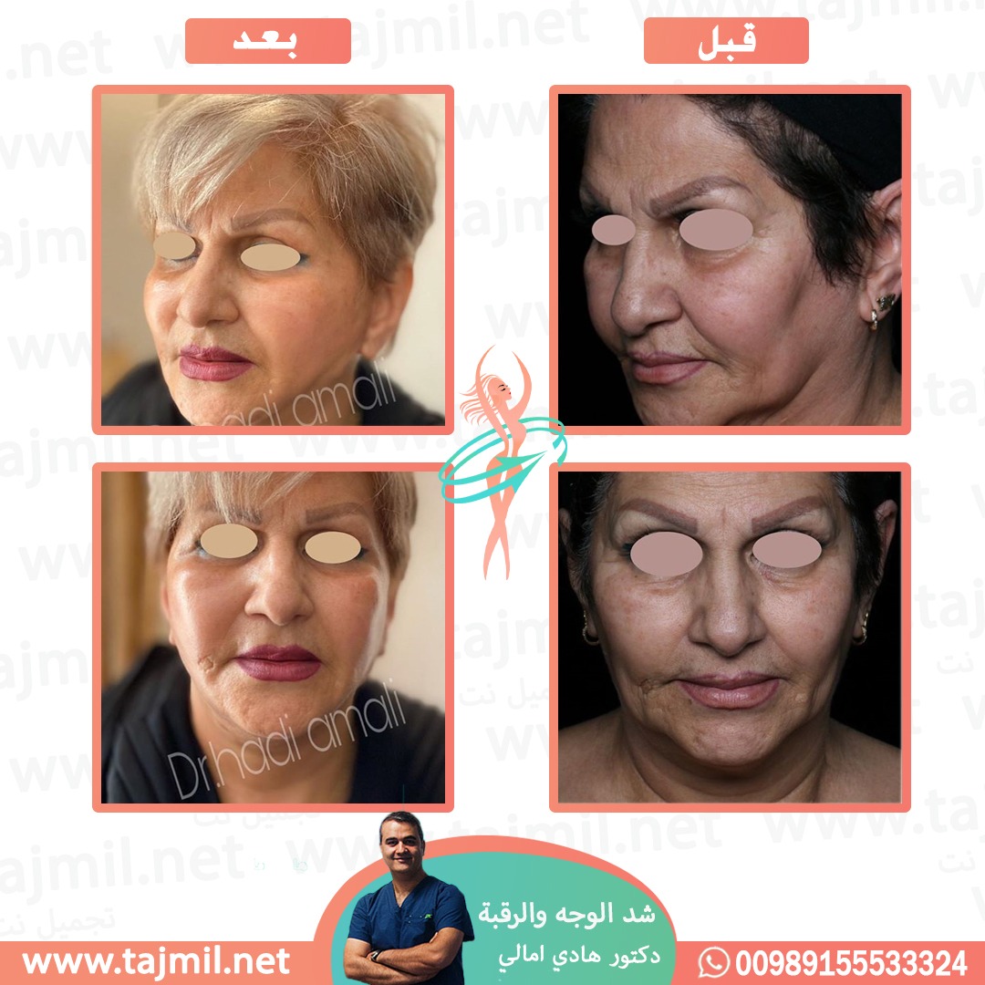  - دکتور هادي امالي عملية شد الوجه و الرقبه  في ايران مع تجميل نت