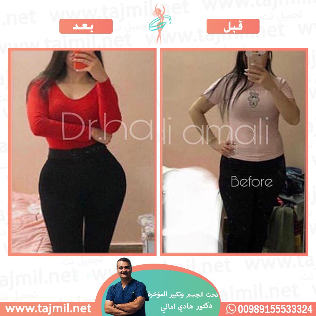  - دکتور هادي امالي عملية نحت الجسم و تکبیر المؤخرة في ايران مع تجميل نت