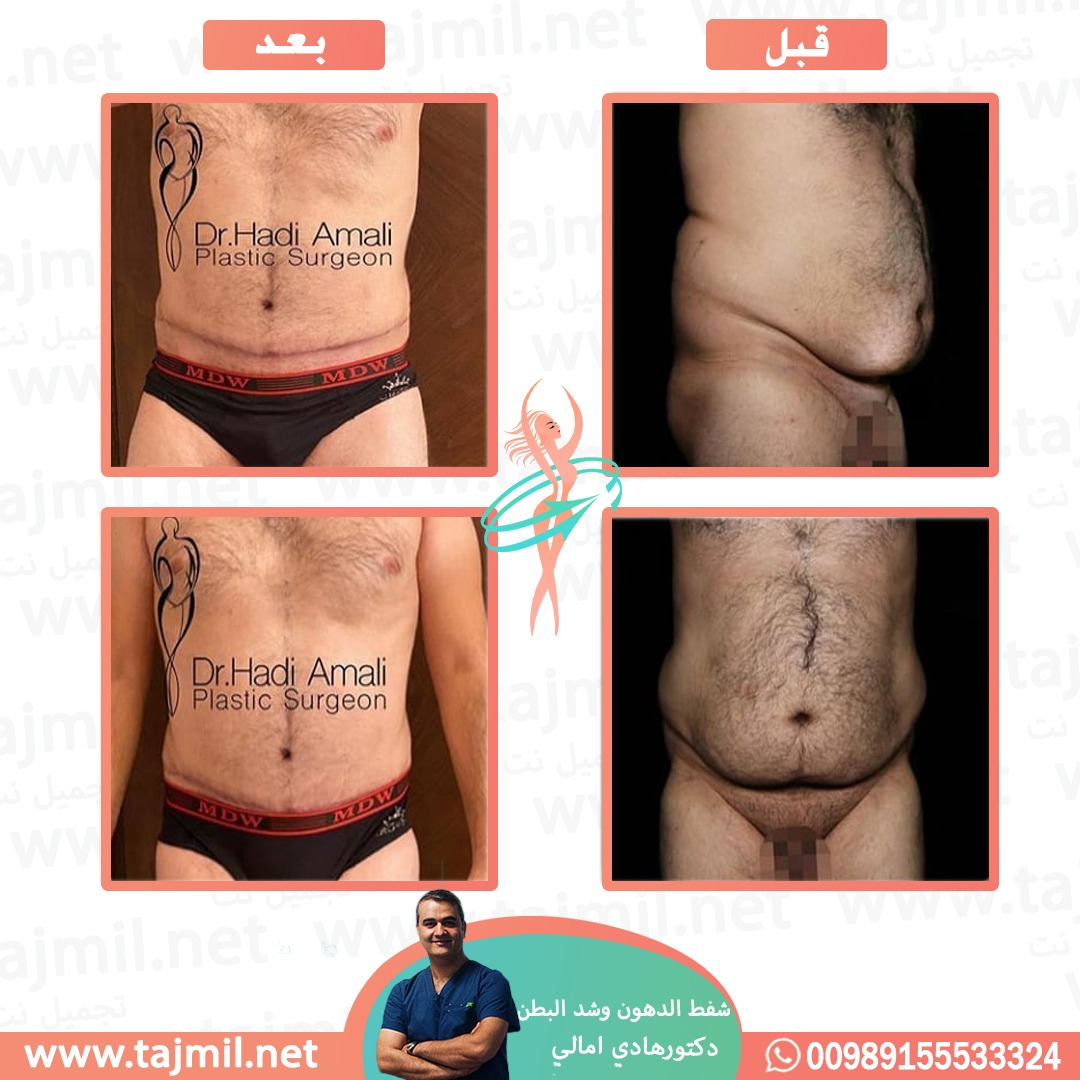  - دکتور هادي امالي عملية شفط الدهون و شد البطن في ايران مع تجميل نت