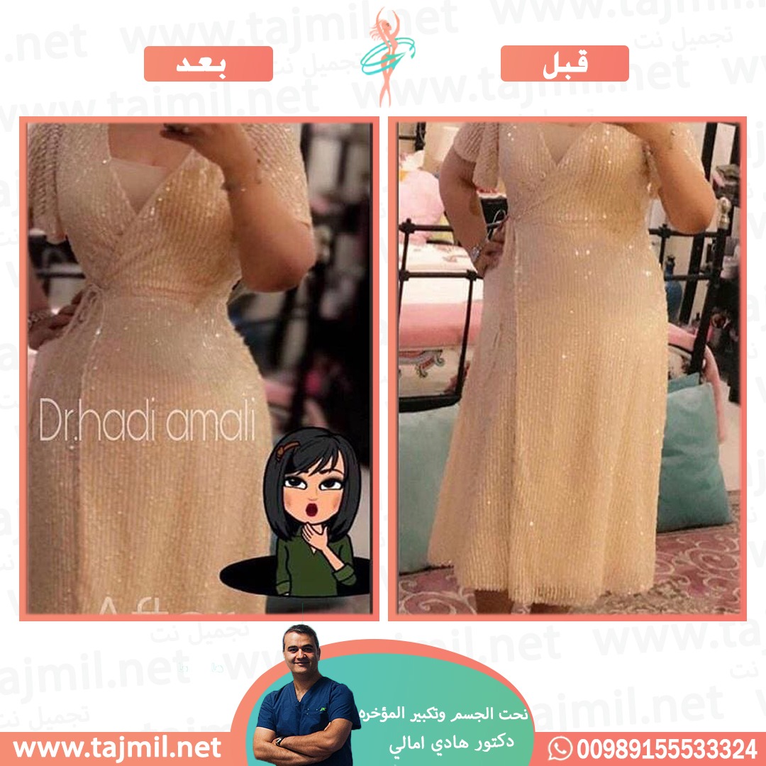  - دکتور هادي امالي عملية نحت الجسم و تکبیر المؤخره في ايران مع تجميل نت