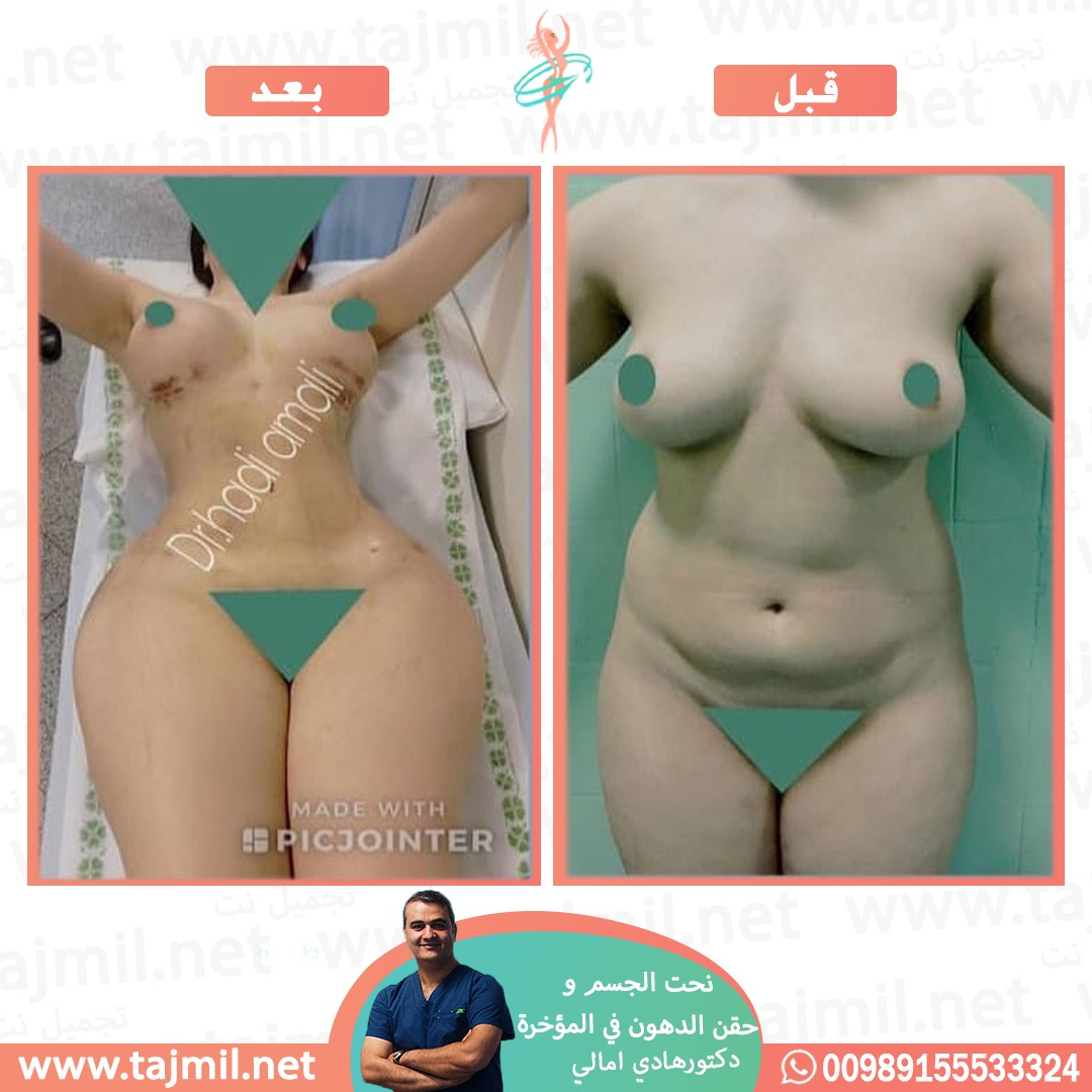  - دکتور هادي امالي عملية نحت الجسم و حقن الدهون في المؤخره في ايران مع تجميل نت