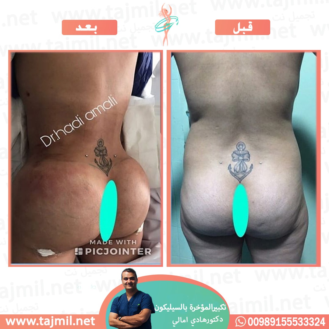  - دکتور هادي امالي عملية تکبیر المؤخرة بالسیلیکون في ايران مع تجميل نت