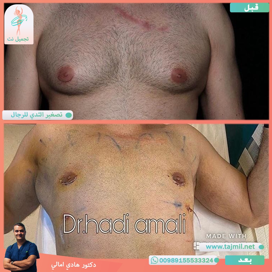  - دکتور هادي امالي عملية تصغیر الثدي للرجال في ايران مع تجميل نت