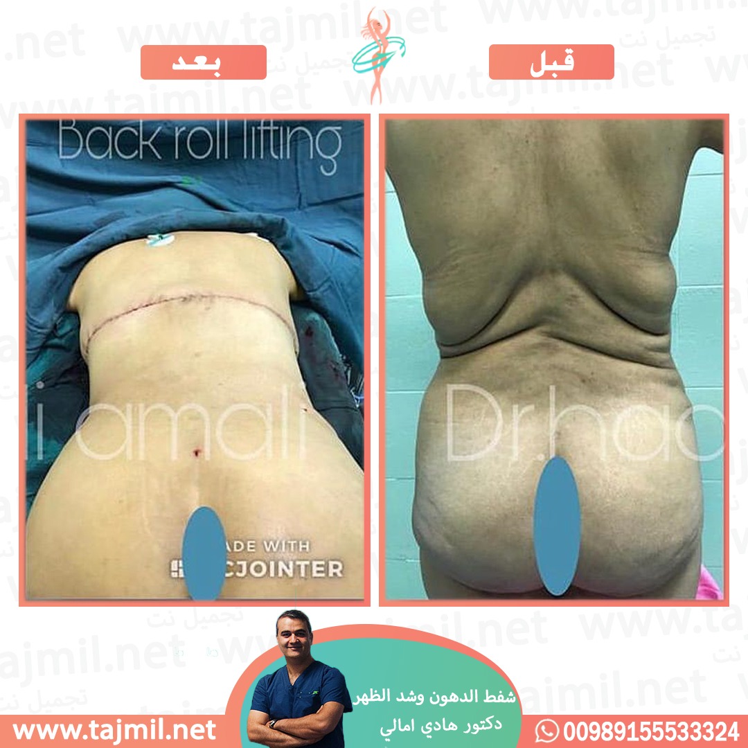  - دکتور هادي امالي عملية شفط الدهون و شد الظهر في ايران مع تجميل نت