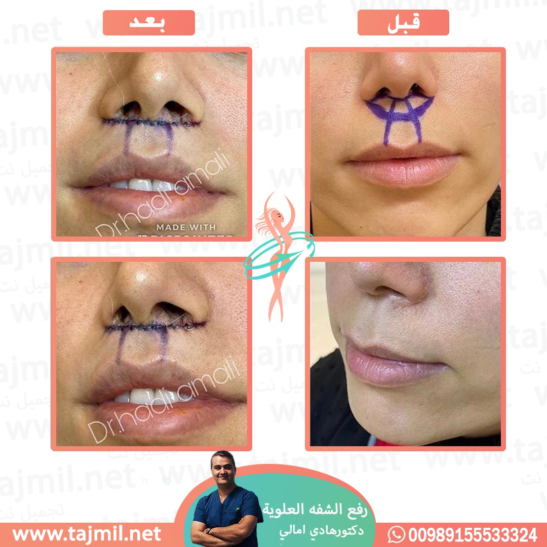  - دکتور هادي امالي عملية رفع الشفه العلویة في ايران مع تجميل نت