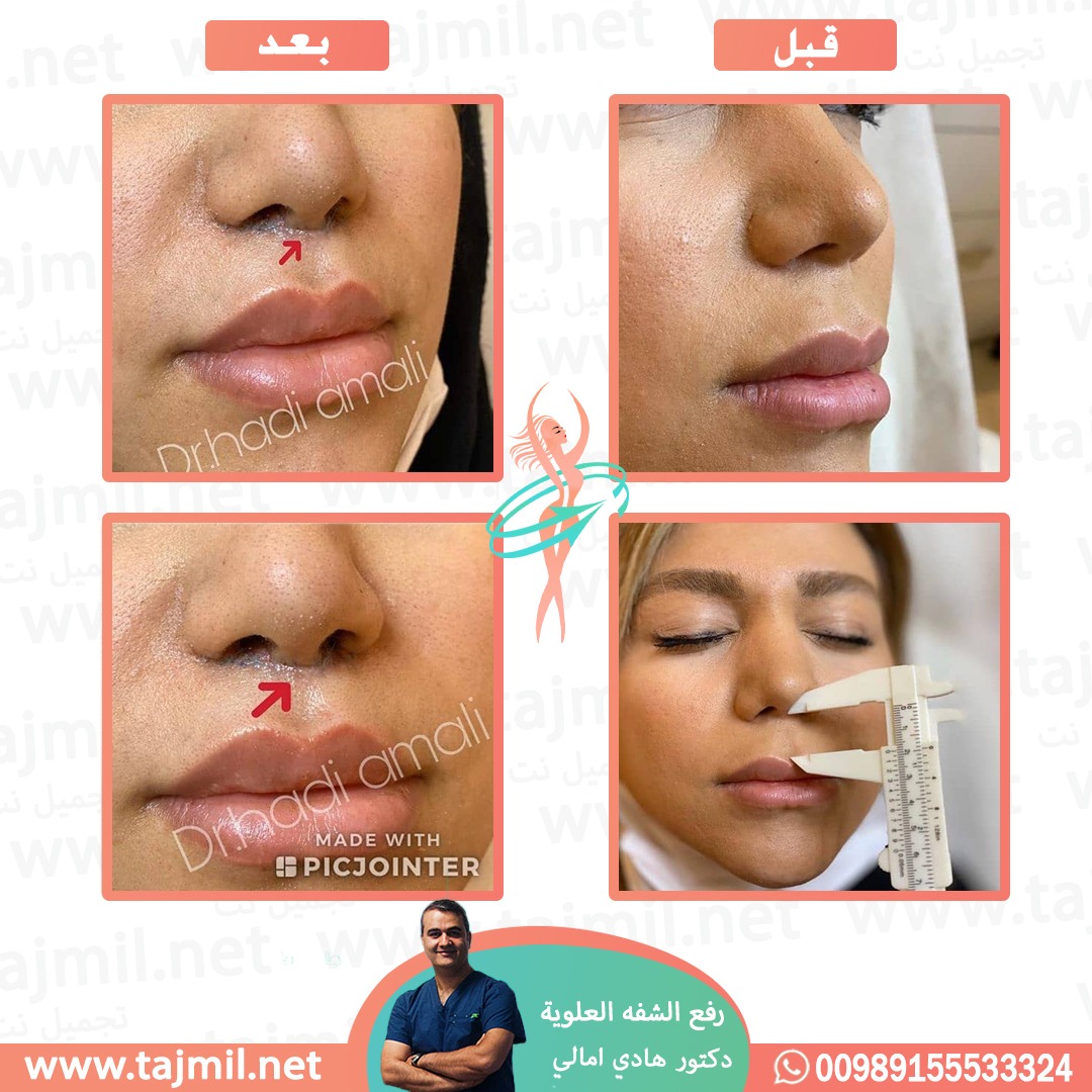  - دکتور هادي امالي عملية رفع الشفه العلویة في ايران مع تجميل نت