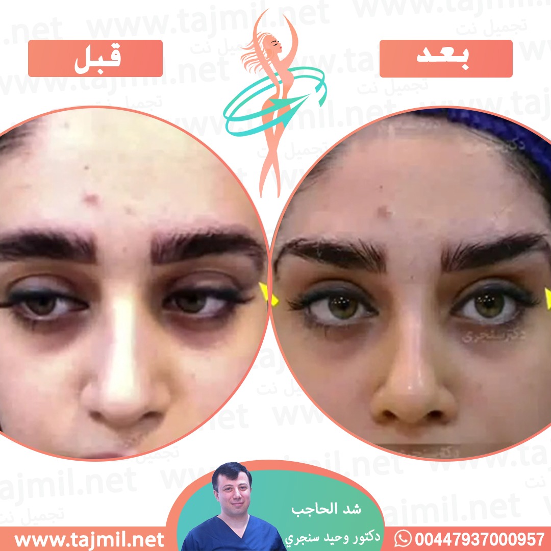  - دکتور وحید سنجري عملية شد الحاجب في ايران مع تجميل نت