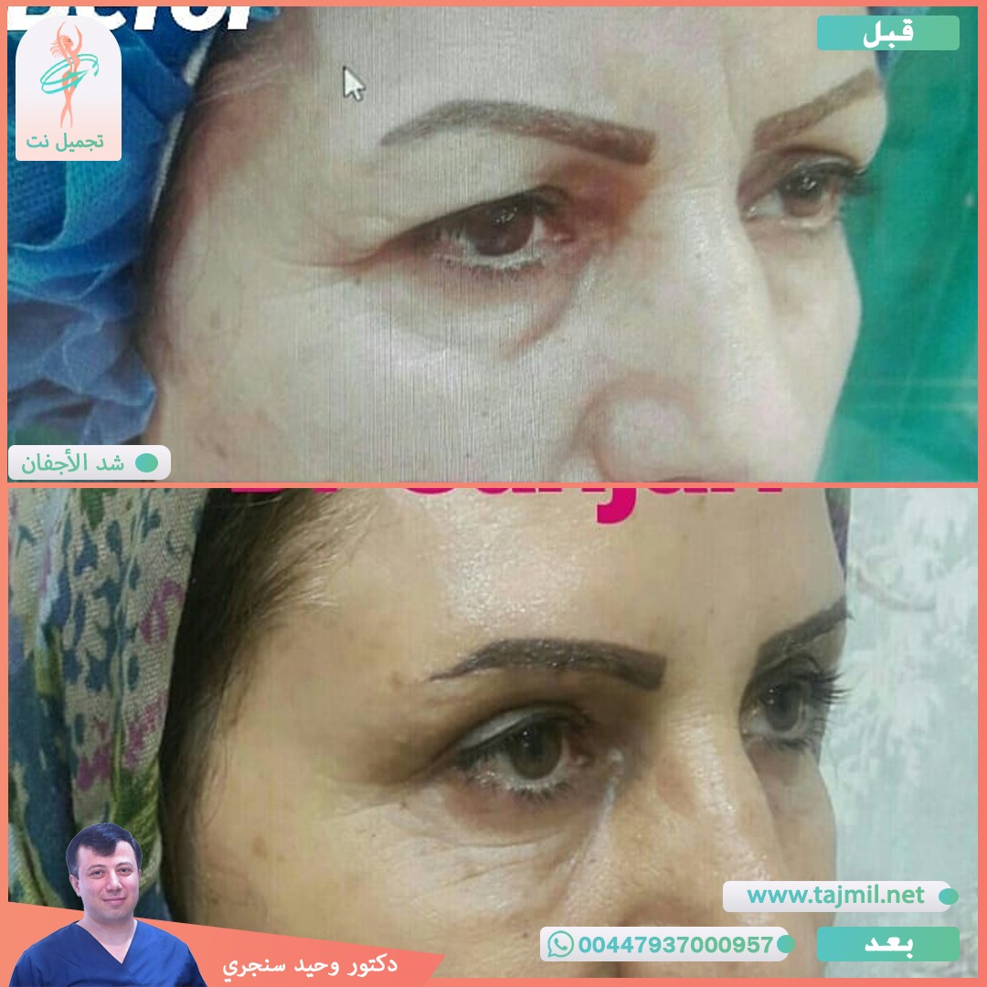  - دکتور وحید سنجري عملية شد الأجفان في ايران مع تجميل نت