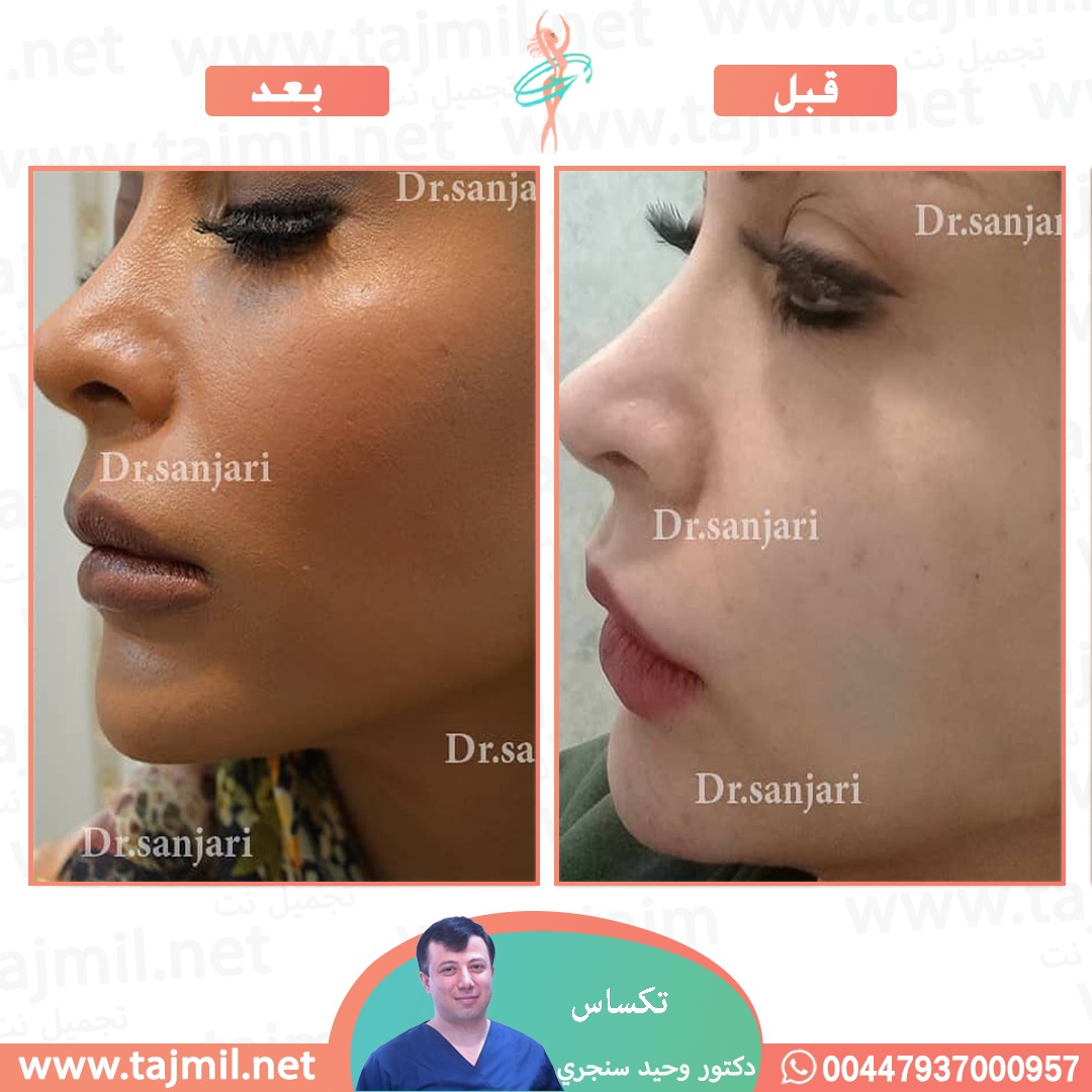  - دکتور وحید سنجري عملية تکساس في ايران مع تجميل نت