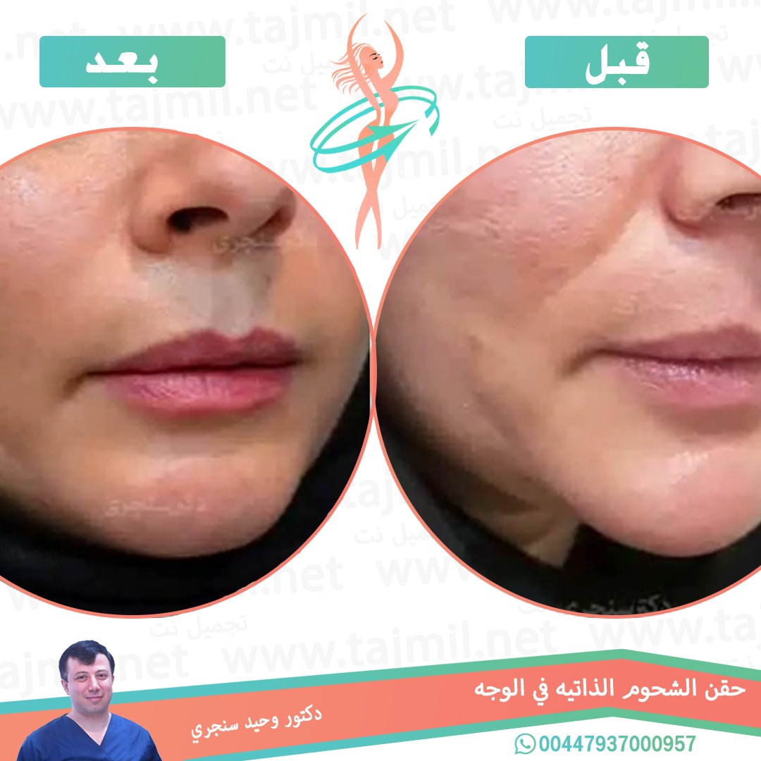  - دکتور وحید سنجري عملية حقن الشحوم  الذاتیه في الوجه في ايران مع تجميل نت