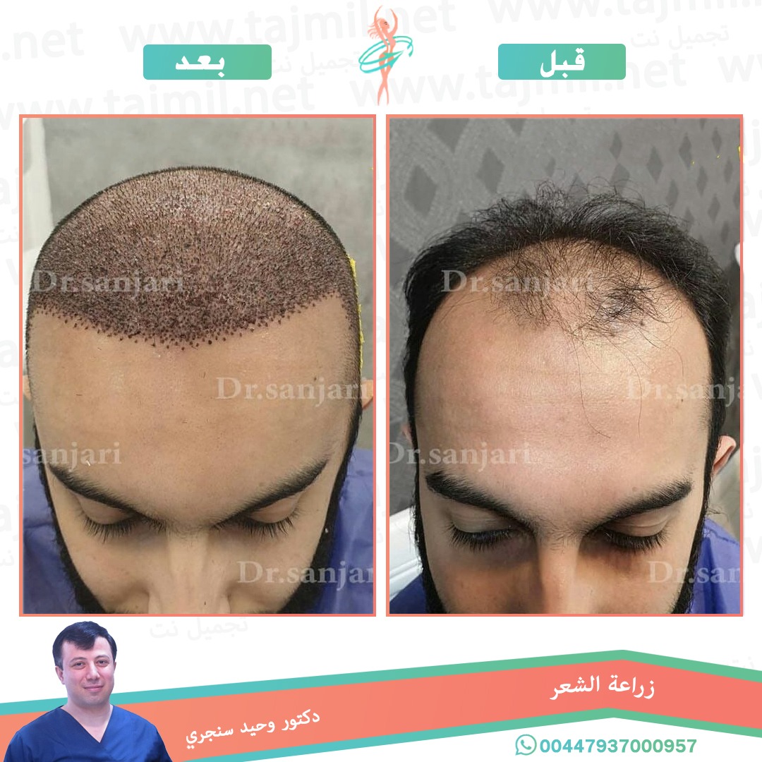  - دکتور وحید سنجري عملية زراعة العشر في ايران مع تجميل نت