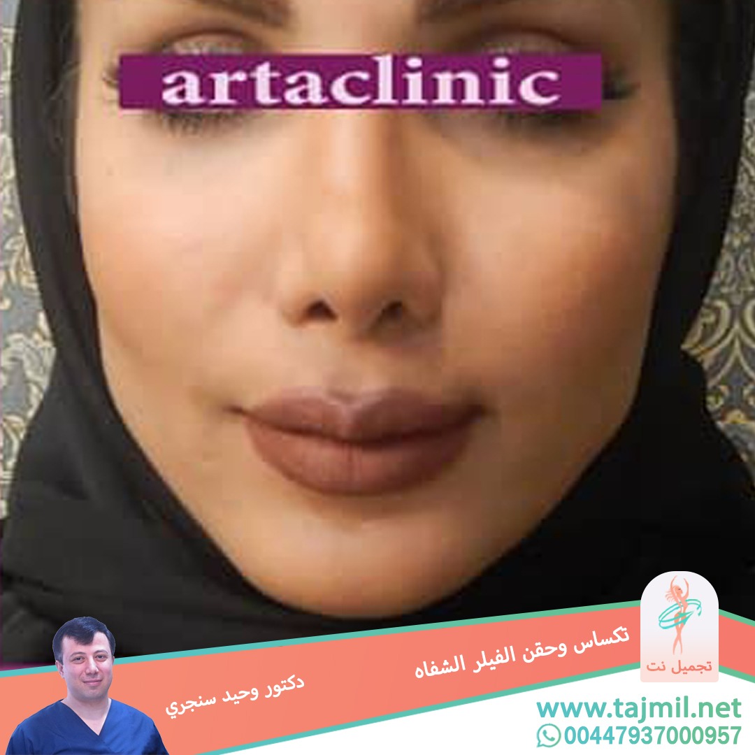  - دکتور وحید سنجري عملية تکساس و حقن الفیلر الشفاه في ايران مع تجميل نت