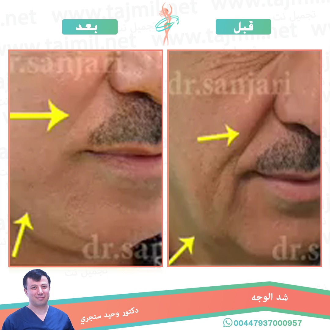  - دکتور وحید سنجري عملية شد الوجه في ايران مع تجميل نت