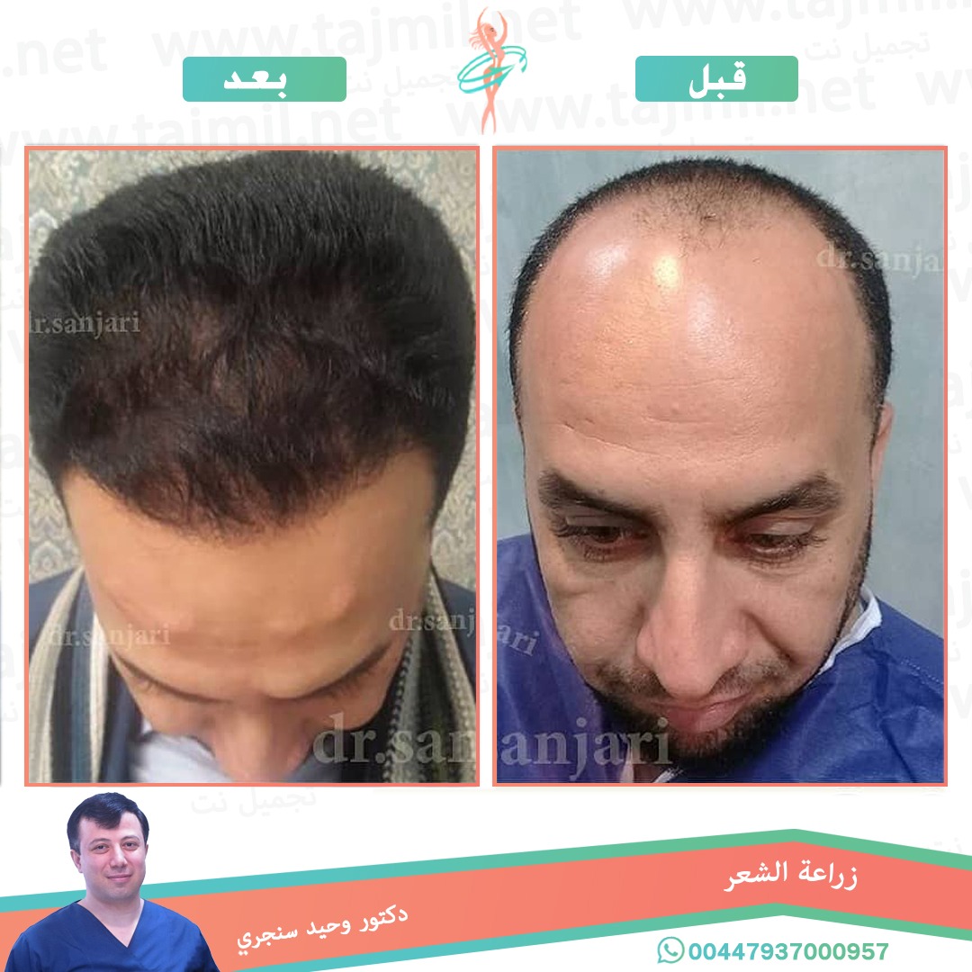  - دکتور وحید سنجري عملية زراعة العشر في ايران مع تجميل نت