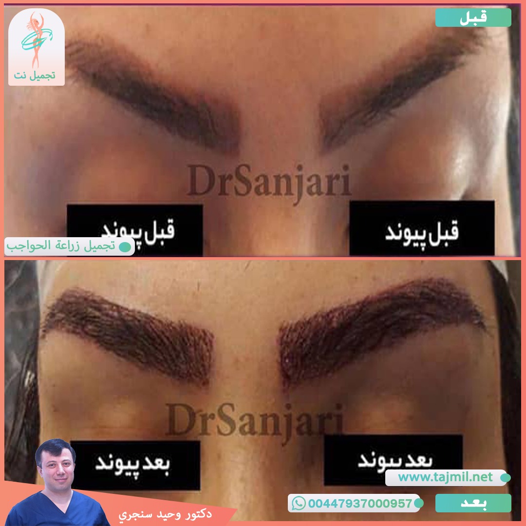  - دکتور وحید سنجري عملية زراعة الحواجب في ايران مع تجميل نت