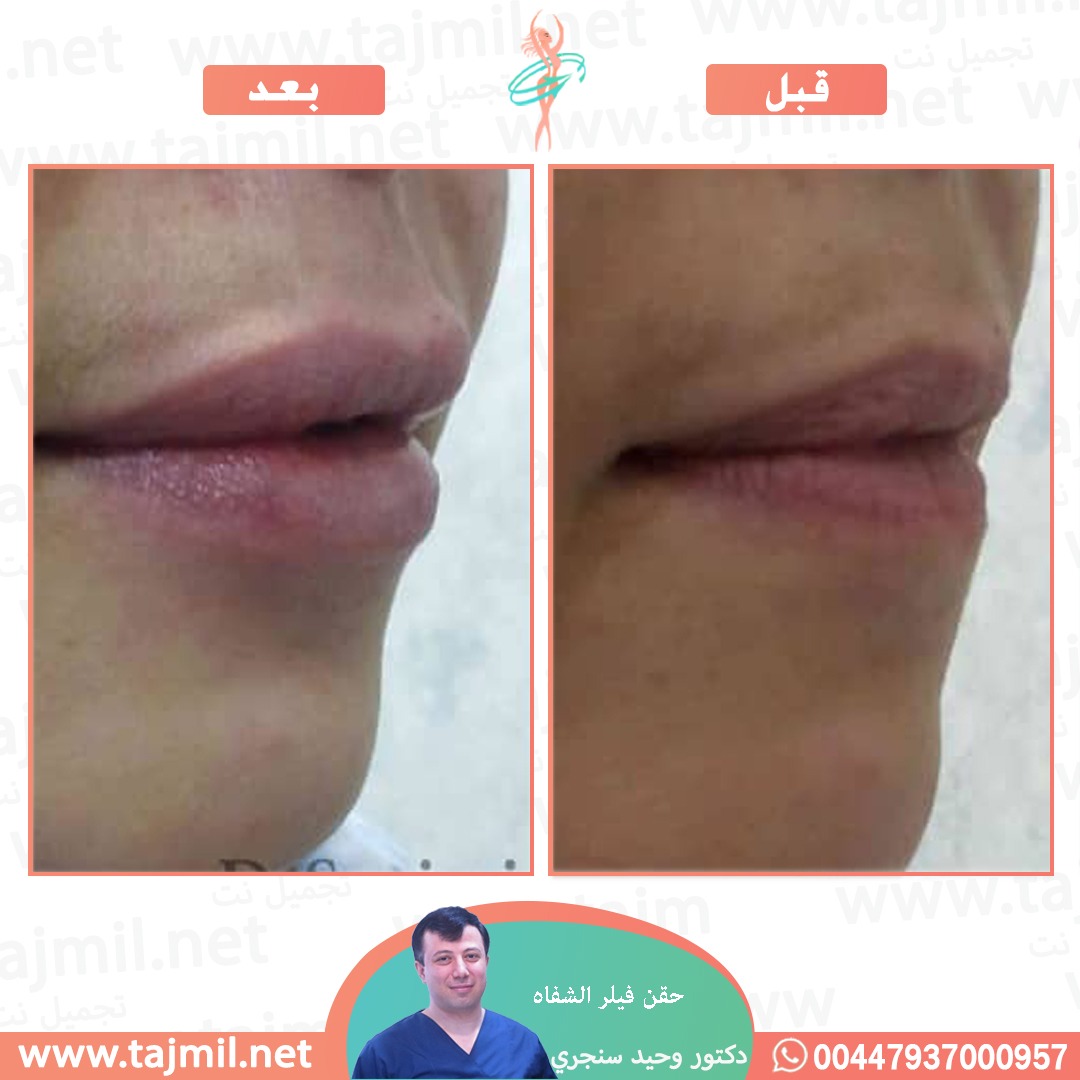  - دکتور وحید سنجري عملية حقن فیلر الشفاه في ايران مع تجميل نت