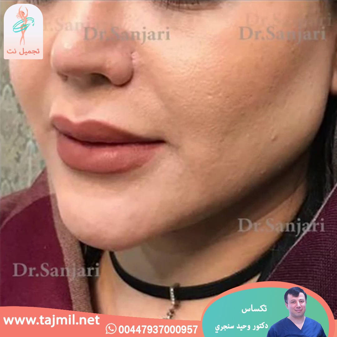  - دکتور وحید سنجري عملية تکساس في ايران مع تجميل نت